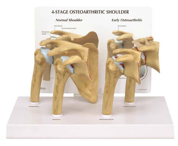 4-Stage Osteoarthritis Shoulder Anatomy Model