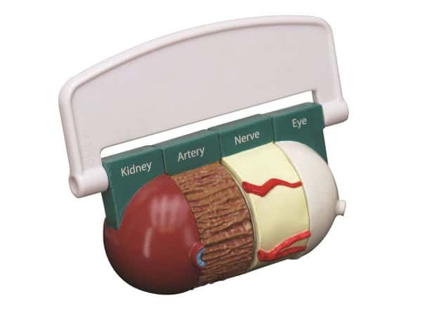 4-Piece Diabetes Anatomy Model