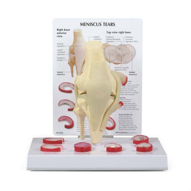 Knee with Meniscus Tears