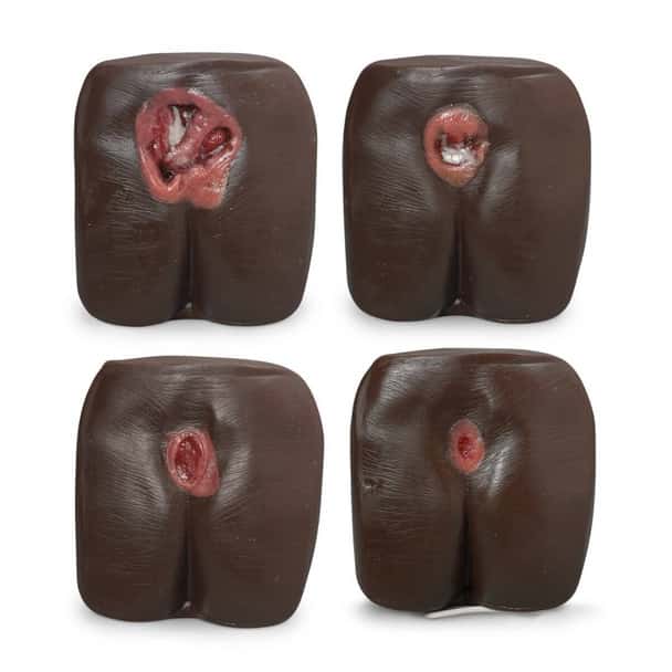 Life/form Pressure Ulcer/Bedsore Model - Dark