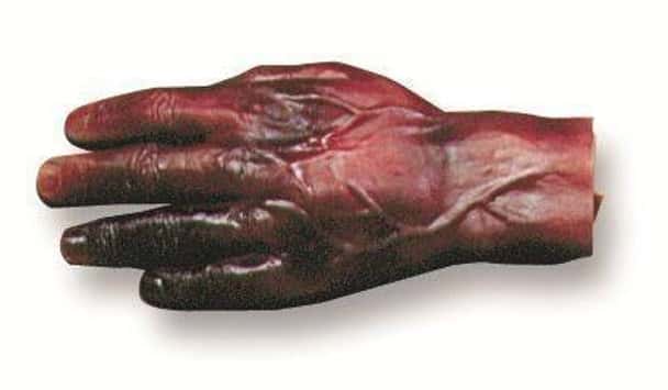 Burn Of The Hand Model 2nd and 3rd Degree