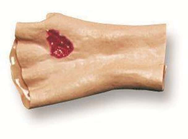 Phosphorous Burn Of The Hand Model
