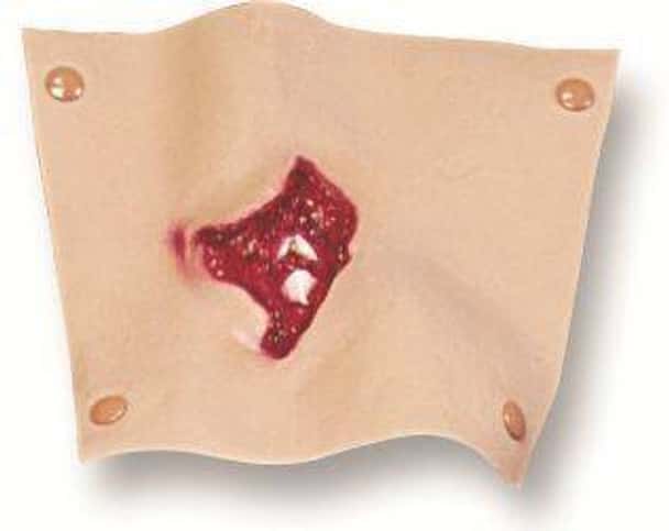 Compound Fracture Of The Humerus Model