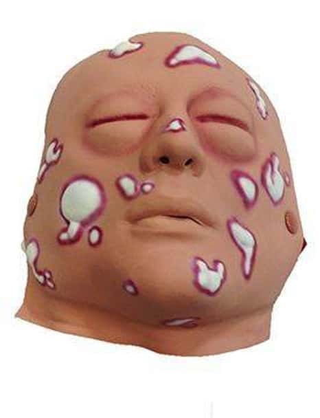 Mustard Gas Moulage