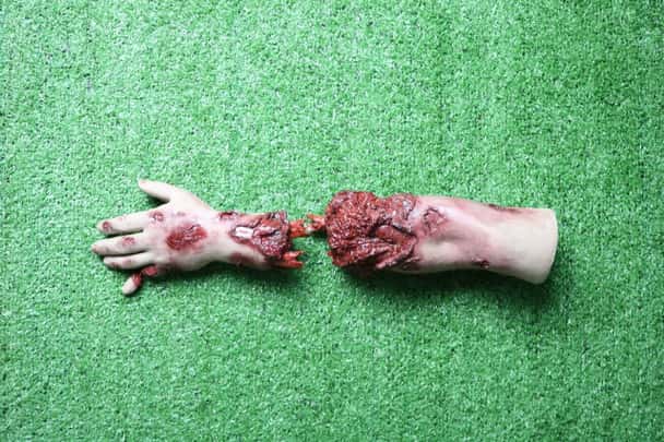 Anatomy Lab Moulage - Left Arm Amputation