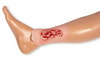 Wound Moulage Venous Leg Ulcer, Small, Exudation Phase