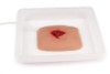 Large Wound Moulage for Wound Packing