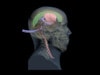 Adult Head (Hematoma) for X-Ray CT, US, MRI