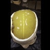 Adult Head (Hematoma) for X-Ray CT, US, MRI