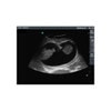 Percutaneous Umbilical Cord Blood Sampling Ultrasound Training Model