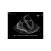 Cardiac Echo Ultrasound Training Model - Transparent