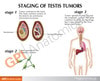 Male Pelvis Anatomy Model With Testicular Cancer