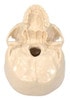 Diseased Brain In Skull Anatomy Model