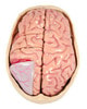 Diseased Brain In Skull Anatomy Model