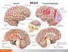 Diseased Brain In Skull Anatomy Model