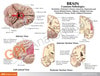 Diseased Brain In Skull Anatomy Model