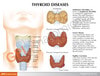 Thyroid Disease Anatomy Model