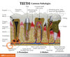 Diseased Teeth and Gums Anatomy Model