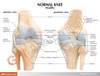 4 Stage Osteoarthritis Knee Set Anatomy Model