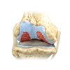 4 Stage Osteoarthritis Knee Set Anatomy Model