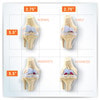 4 Stage Osteoarthritis Knee Set Anatomy Model