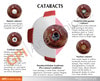Cataract Eye Anatomy Model