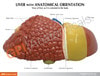 Diseased Liver Anatomy Model