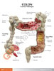 Colon Anatomy Model With Pathologies