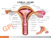 Uterus and Ovary Anatomy Model With Pathologies