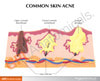 Acne Skin Anatomy Model