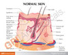 Acne Skin Anatomy Model