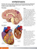Hypertension Anatomy Model Set