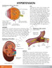 Hypertension Anatomy Model Set