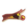 Hypertension Anatomy Model Set