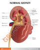 Diseased Kidney Anatomy Model