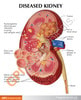 Diseased Kidney Anatomy Model