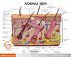 Skin Burn and Normal Skin Anatomy Model
