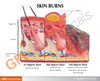 Skin Burn and Normal Skin Anatomy Model