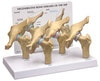 4-Stage Arthritic Hip Anatomy Model