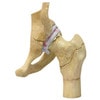 4-Stage Arthritic Hip Anatomy Model