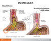 Gastroesophageal Reflux Disease Anatomy Model Gerd