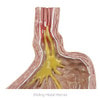 Gastroesophageal Reflux Disease Anatomy Model Gerd