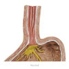 Gastroesophageal Reflux Disease Anatomy Model Gerd