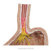 Gastroesophageal Reflux Disease Anatomy Model Gerd