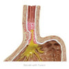 Gastroesophageal Reflux Disease Anatomy Model Gerd