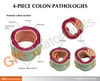 4-Piece Colon With Pathologies Anatomy Model