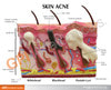 Skin Normal/Acne Anatomy Model