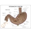 Stomach Cancer Anatomy Model