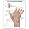Rheumatoid Arthritis Hand Anatomy Model