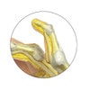 Rheumatoid Arthritis Hand Anatomy Model